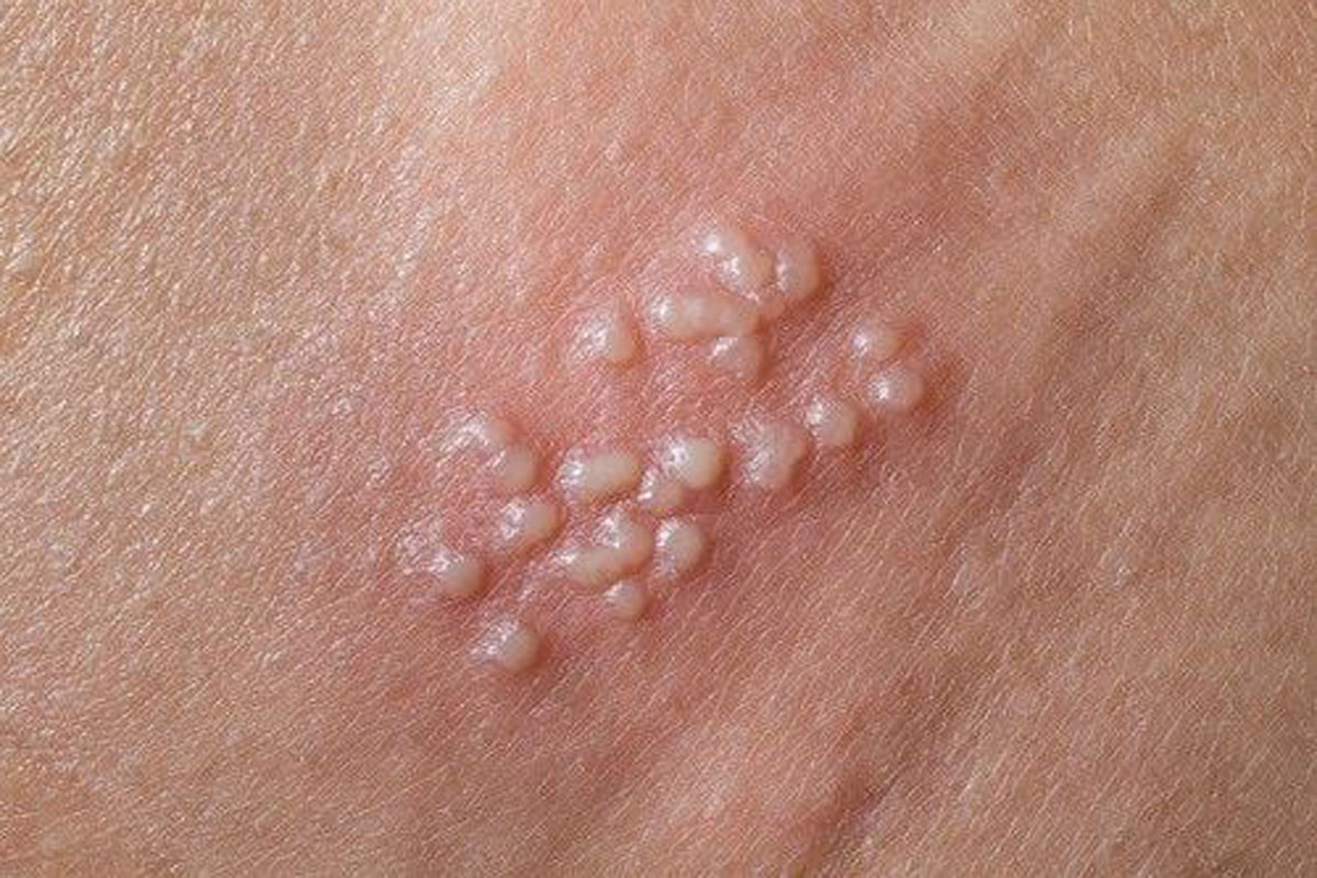 نحوه انتقال بیماری زگیل تناسلی به چه صورت است و چگونه درمان میشود؟