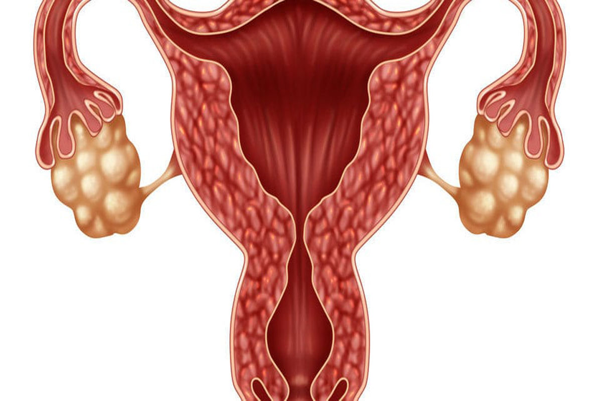کیست تخمدان تا چه اندازه خطرناک است و چگونه درمان می شود؟